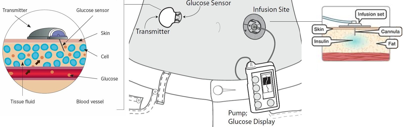 Insulin Pumps and CGM Devices: Islamic Permissibility of Use During Ghusl